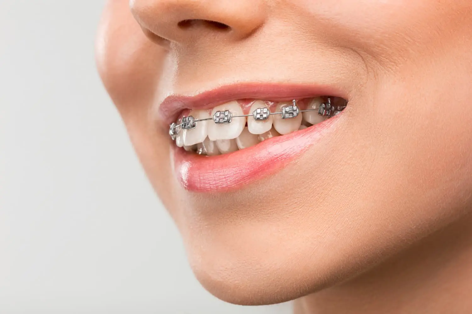 A woman with braces smiling, displaying her overbite at Sweet Smiles Orthodontics in Arlington, MA