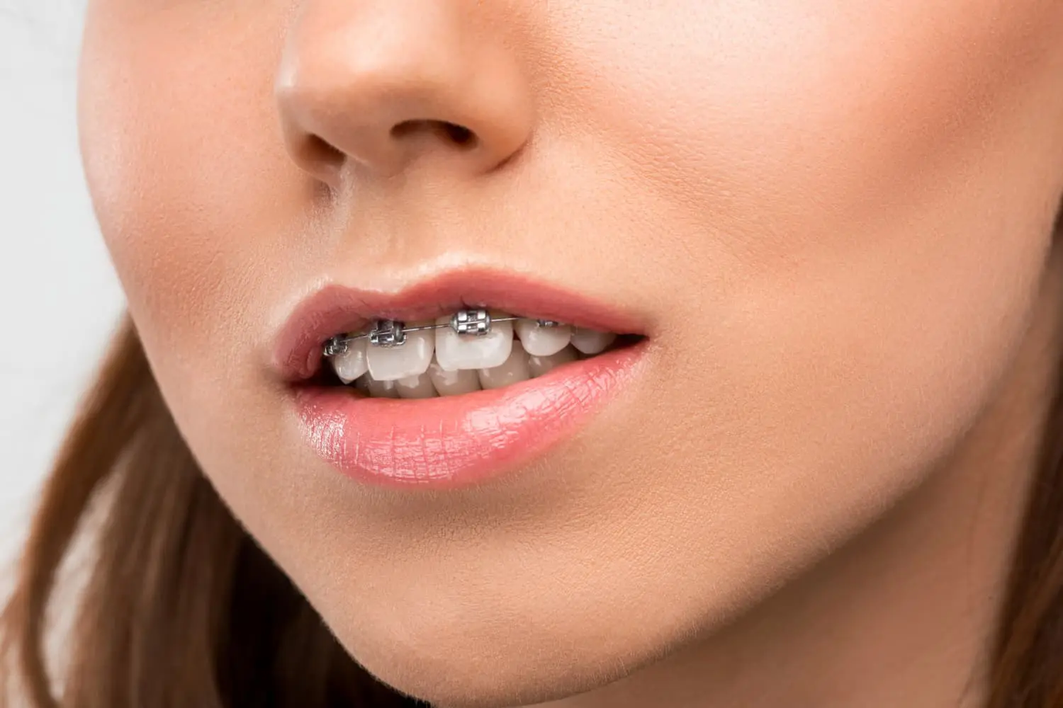 A woman wearing braces displays her overbite during a visit to Sweet Smiles Orthodontics in Arlington, MA