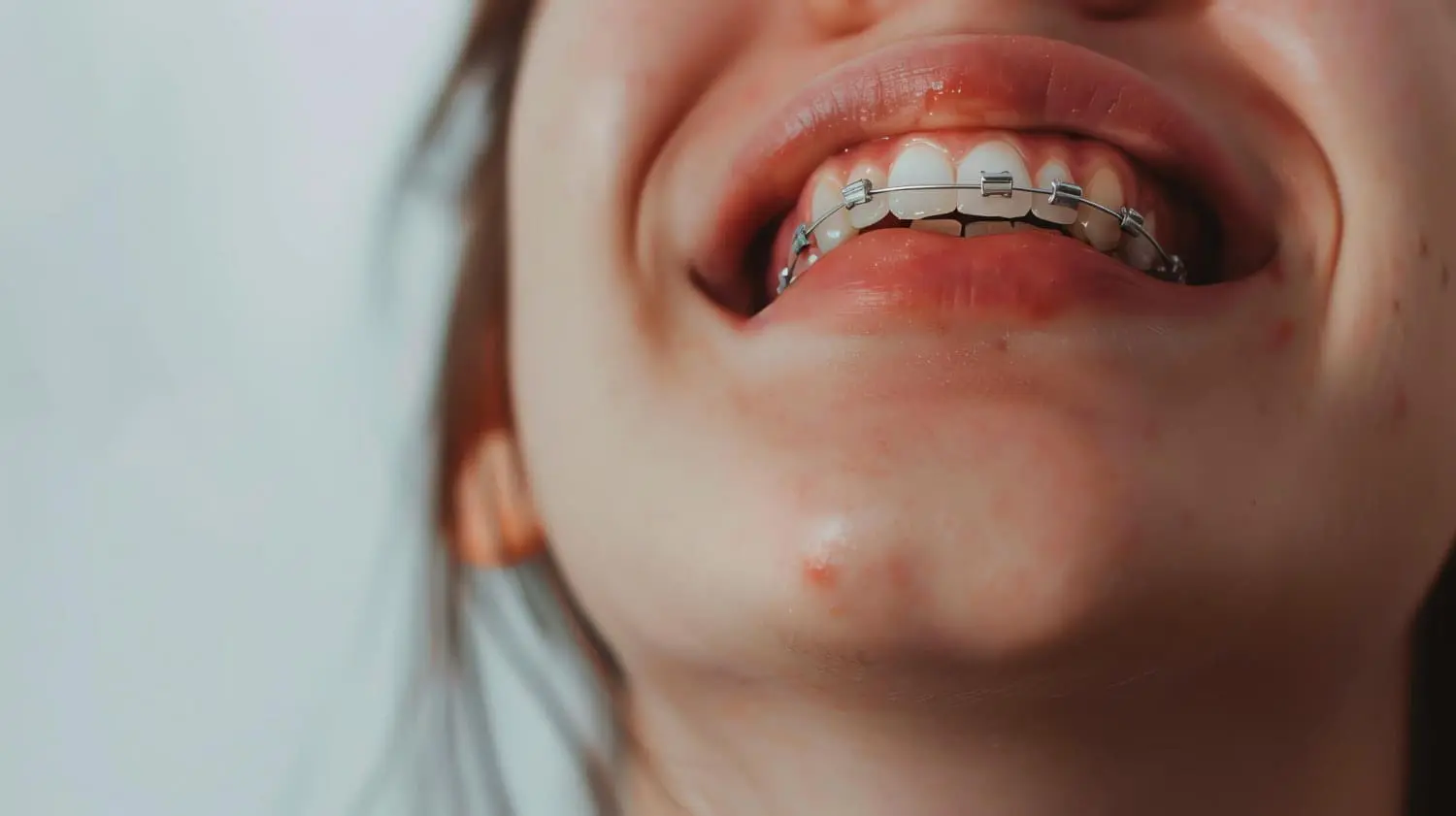 A woman with braces smiling at Sweet Smiles Orthodontics, showcasing her overbite in Arlington, MA
