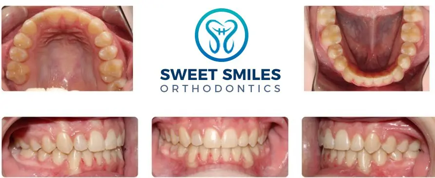 Before-and-after dental arch and front teeth alignment images, with Sweet Smiles Orthodontics in Arlington, MA logo centered.