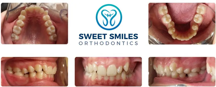 Six dental close-ups displaying teeth alignment and bite before dental care with braces surround the Sweet Smiles Orthodontics logo in Arlington, MA.