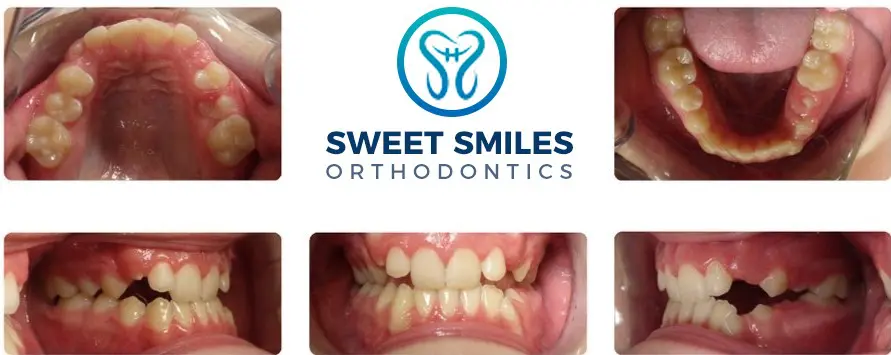 Around the Sweet Smiles Orthodontics logo in Arlington, MA, six images show common orthodontic issues before braces.