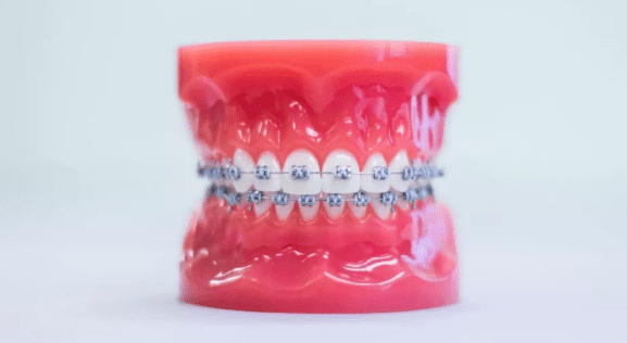 Teeth with metal braces on both jaws are shown on a dental model for Sweet Smiles Orthodontics in Arlington, MA.