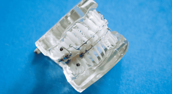 A clear dental model with metal braces is displayed on a blue background at Sweet Smiles Orthodontics in Arlington, MA.