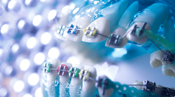 A dental model with multicolored metal braces on both rows of teeth, seen at Sweet Smiles Orthodontics in Arlington, MA.