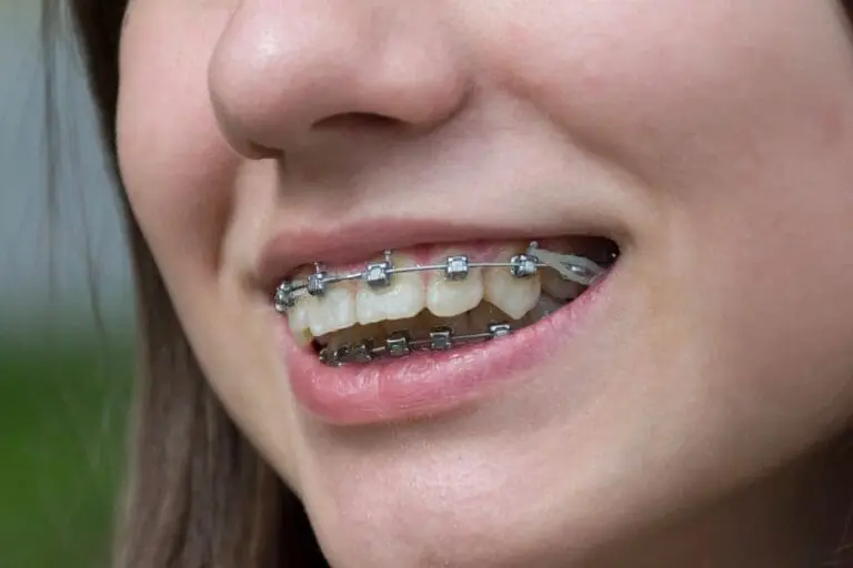 Smiling girl with metal braces on her teeth at Sweet Smiles Orthodontics in Arlington, MA – Learn How to Fix Overbite.