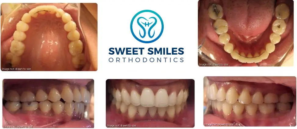 Braces before-and-after close-ups show teeth alignment improvements around the Sweet Smiles Orthodontics logo in Arlington, MA.