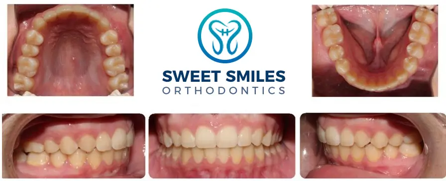 Five dental images of teeth before and after braces surround the Sweet Smiles Orthodontics logo in Arlington, MA.