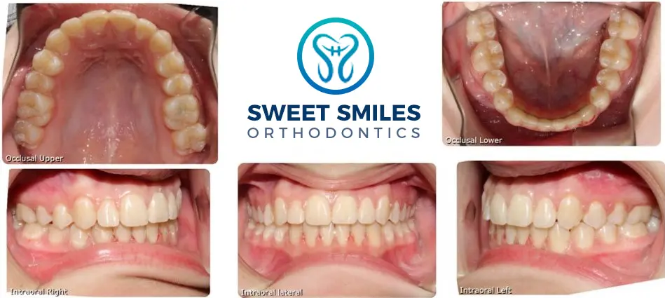 Before and after braces collage with upper, lower, and side teeth views around the Sweet Smiles Orthodontics logo in Arlington, MA.