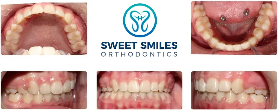Five dental images show teeth and gums before and after braces, with Sweet Smiles Orthodontics in Arlington, MA, logo above.