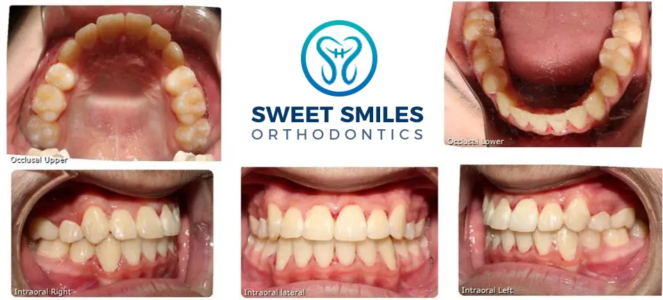 Five dental close-ups show teeth alignment before and after braces, with Sweet Smiles Orthodontics in Arlington, MA logo centered.