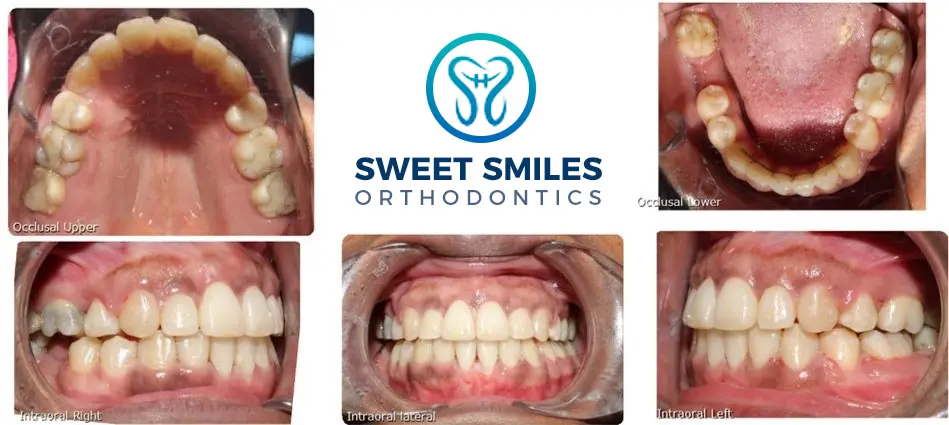 Before and after dental photos with multiple views surround the Sweet Smiles Orthodontics logo in Arlington, MA.