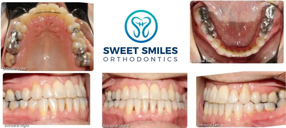 Close-up collage of teeth before and after braces with Sweet Smiles Orthodontics in Arlington, MA logo centered.