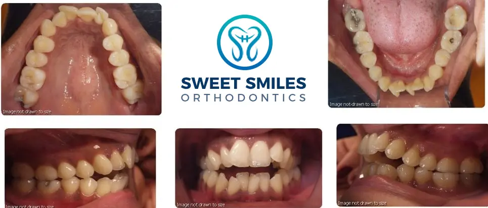 Five dental photos display teeth before and after braces, with the Sweet Smiles Orthodontics logo centered in Arlington, MA.