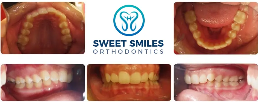 Six dental close-ups show braces before and after alignment, logo and text for Sweet Smiles Orthodontics in Arlington, MA at center.