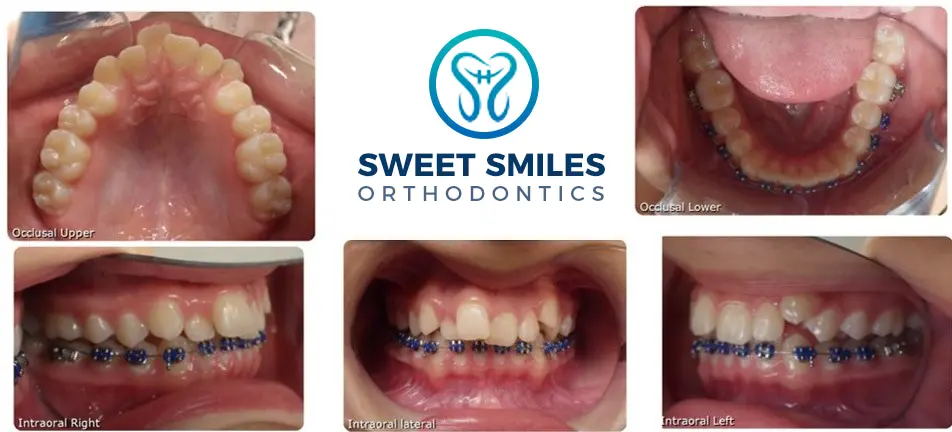 Five close-ups of teeth before and after braces surround the Sweet Smiles Orthodontics logo in Arlington, MA.