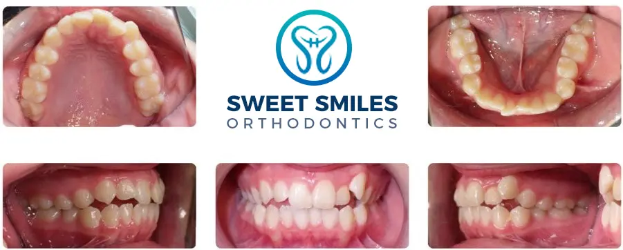 Before and after braces results in six close-up dental images, Sweet Smiles Orthodontics in Arlington, MA logo centered above.