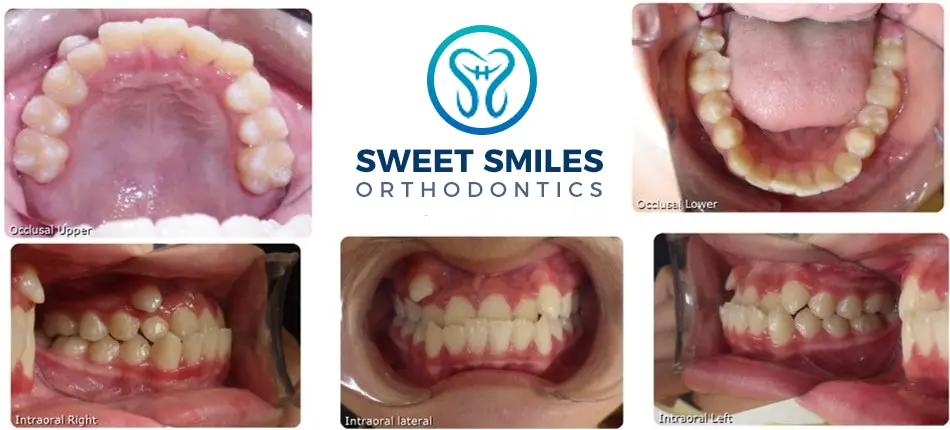 Five dental images show before and after braces results, Sweet Smiles Orthodontics in Arlington, MA logo centered.