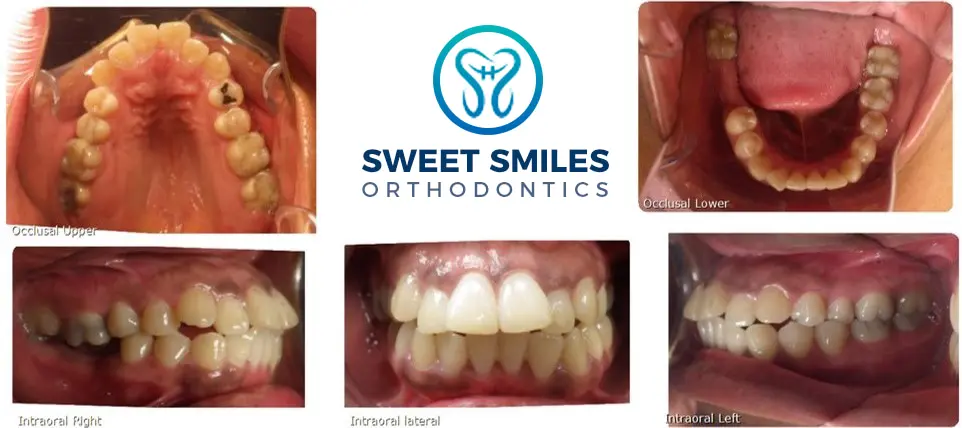 Dental collage with before-and-after occlusal and lateral shots; Sweet Smiles Orthodontics in Arlington, MA logo at center.
