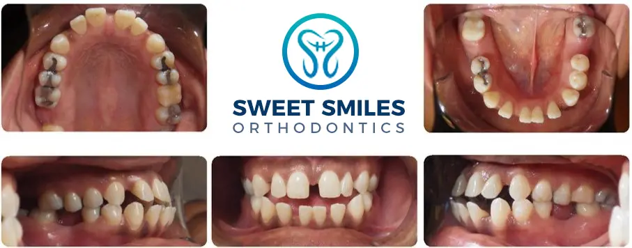 Six dental before-and-after braces photos from various angles, with Sweet Smiles Orthodontics in Arlington, MA logo at the center.