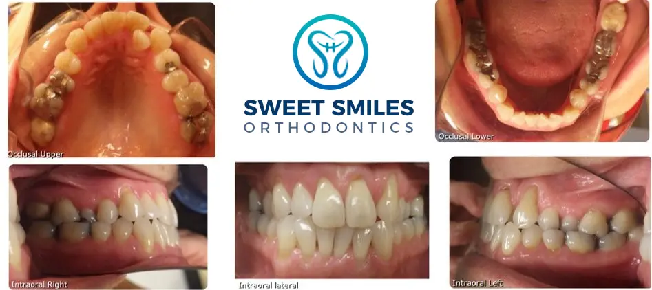 Six dental images show before and after braces at Sweet Smiles Orthodontics in Arlington, MA, logo centered.
