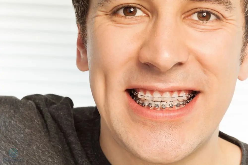 A smiling man with braces, shown from the shoulders up at Sweet Smiles Orthodontics in Arlington, MA - Overbite vs Underbite in Arlington, MA