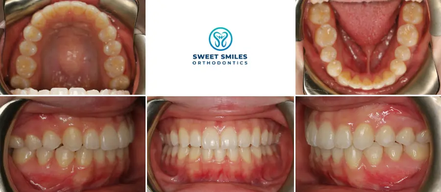Dental images display arches and teeth alignment before and after Invisalign at Sweet Smiles Orthodontics in Arlington, MA.