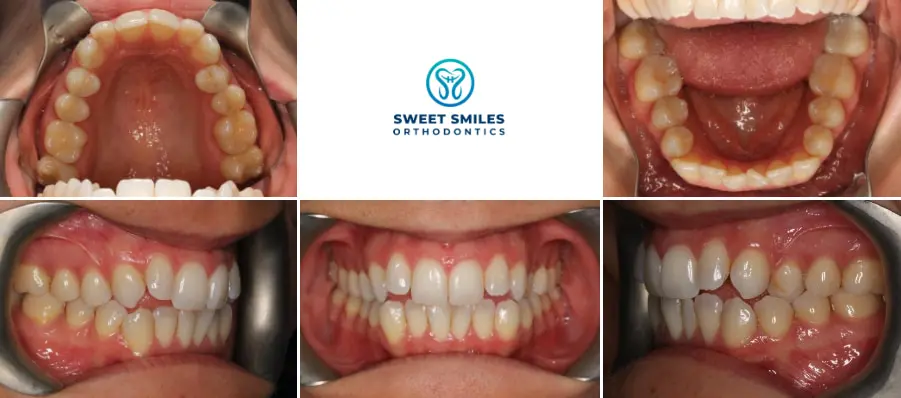 Close-up collage of Invisalign results on a patient's teeth, Sweet Smiles Orthodontics logo center, in Arlington, MA.