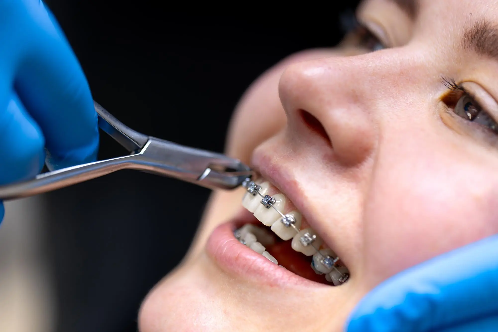 A close-up of braces removal with dental pliers at Sweet Smiles Orthodontics in Arlington, MA, showing a gloved hand at work.
