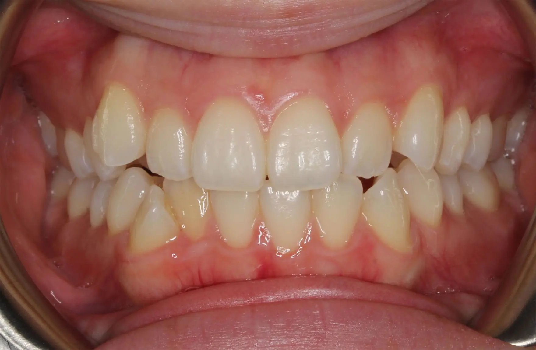 Before Invisalign at Sweet Smiles Orthodontics in Arlington, MA: close-up of slightly misaligned teeth and healthy pink gums.