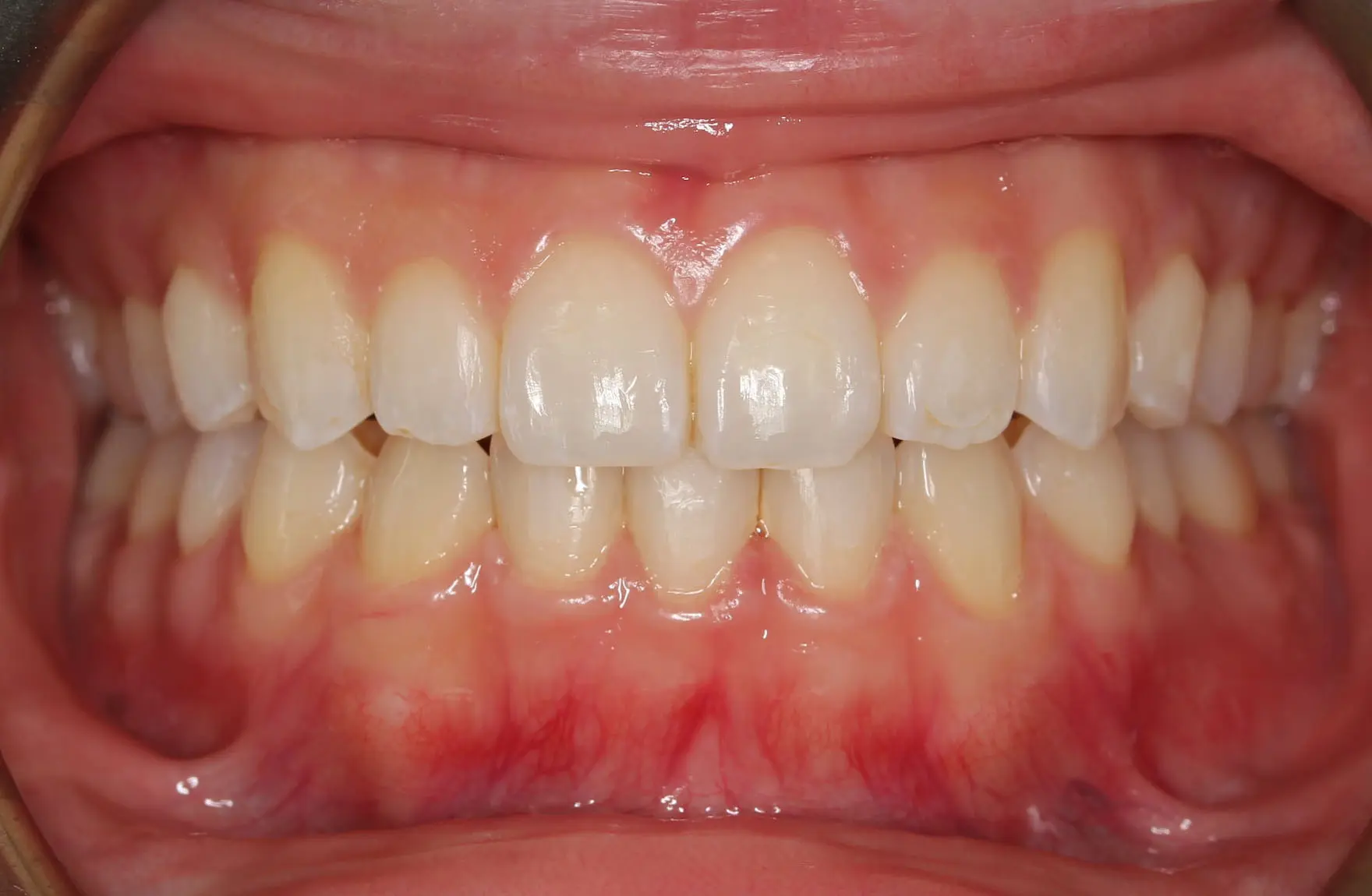 A close-up of clean, aligned teeth and healthy gums after Invisalign at Sweet Smiles Orthodontics in Arlington, MA.