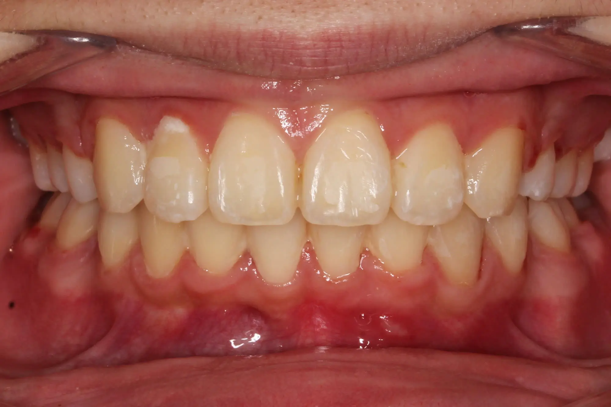 Teeth and gums after braces at Sweet Smiles Orthodontics in Arlington, MA; mild gum redness and a white spot visible.