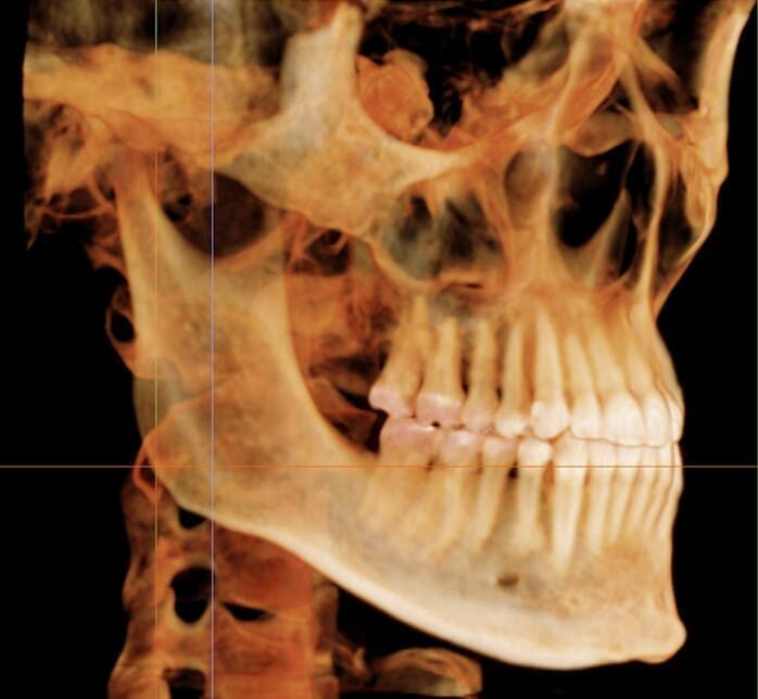 Side-view 3D dental X-ray highlighting bone and teeth alignment at Sweet Smiles Orthodontics in Arlington, MA.